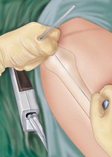 Illustration 16 for Arthrodesis with an Intramedullary Nail: Fixing Failed TKAs