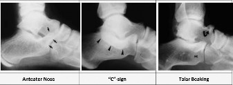 Pediatric Ankle Pain: Diagnosis Involves the Subtalar Joint