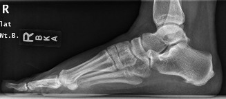 Unraveling Heel Pain: Diagnosing Lateral Plantar Nerve Entrapment