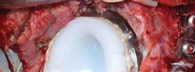 Illustration 59 for Management of Periprosthetic Fractures: An Expert Surgical Guide