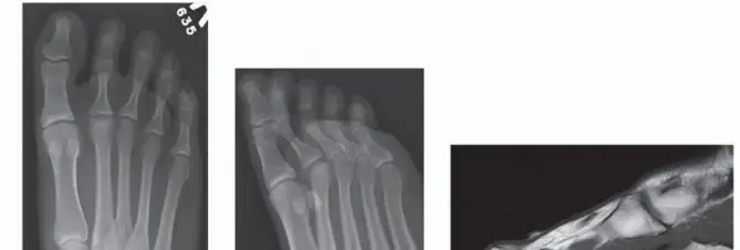 صورة توضيحية لـ داء فرايبرغ: دليل شامل للمرضى نحو قدم خالية من الألم مع الأستاذ الدكتور محمد هطيف