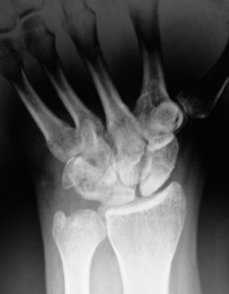 Illustration 3 for Christine M Kleinert Discussion: Solving Difficult Wrist Fractures