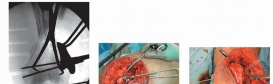 Illustration 49 for Repairing Distal Femur Fractures: Open Reduction & Internal Fixation