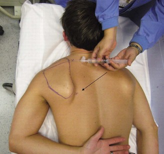 Illustration 58 for Right Shoulder Pain? Avoid This Common X-ray Mistake.