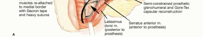Illustration 15 for Mastering Total Scapular Resections: Reconstruction & Outcomes