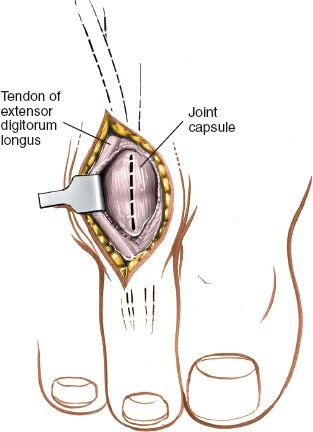 Illustration 219 for Optimized Approaches to the Dorsum of the Foot & Ankle