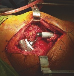 Illustration 9 for Acetabular Augment: Rebuilding Bone in Complex Revision