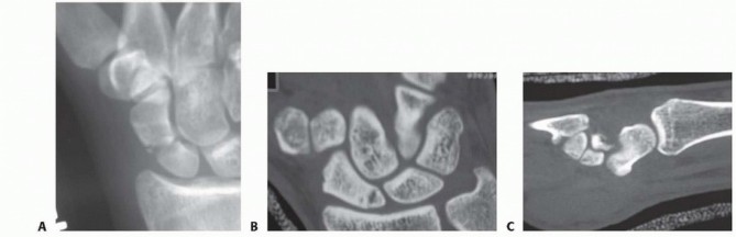 Illustration of nondisplaced scaphoid waist - Dr. Mohammed Hutaif
