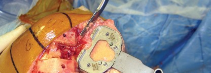 صورة طبية: استبدال مفصل الركبة بالحد الأدنى من التدخل الجراحي: ألم أقل وتعافٍ أسرع مع النهج شبه الرضفي الإنسي