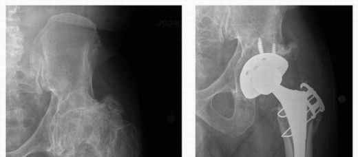 Illustration 11 for Overcoming Proximal Femoral Deformity in THA: Key Strategies