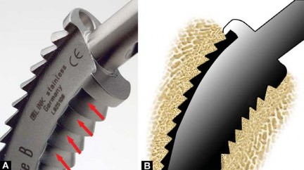 Illustration 45 for Collum Femoris Preserving: Achieve Better Primary Hip Outcomes