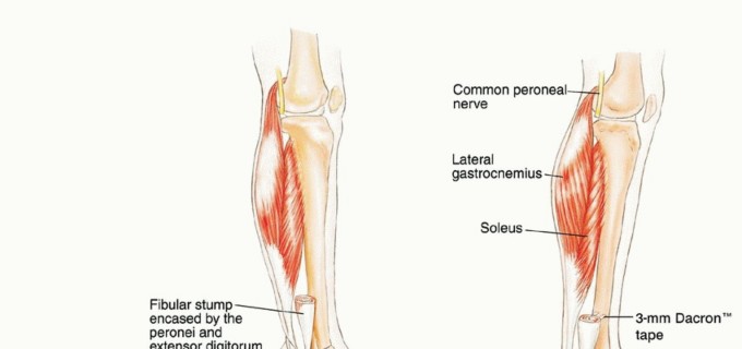Illustration 28 for Beyond Amputation: The Type I Resection in Fibular Tumor Surgery
