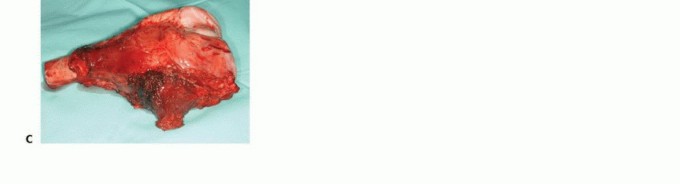 Illustration 32 for Precision Biopsy of Musculoskeletal Tumors for Accurate Diagnosis