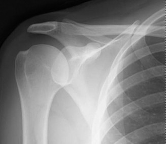 Right Shoulder Pain? Avoid This Common X-ray Mistake.