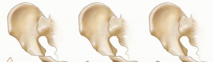 Illustration 24 for Septic Hip in Children: Mastering Anterior Drainage for Optimal Recovery