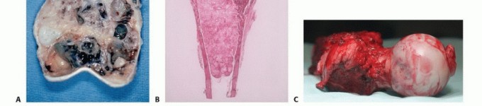 Illustration 11 for Precision Biopsy of Musculoskeletal Tumors for Accurate Diagnosis