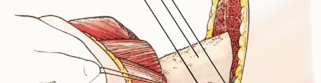 Illustration 23 for Anterior Flap Hemipelvectomy: Leveraging fig tech fig for Difficult Tumors
