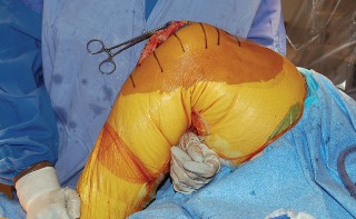 Illustration 43 for Mastering Gap Balancing in Revision TKA: Avoid Common Pitfalls