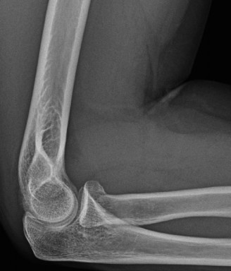 Illustration 2 for Stiff Elbow Cases: Diagnosing & Treating Post-Traumatic Contractures