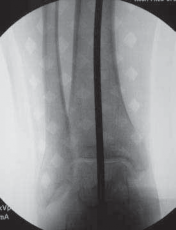Illustration 25 for Guide Pin Assembly: Key to Flawless Upper Tibial Osteotomy