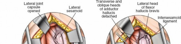 Illustration 210 for Optimized Approaches to the Dorsum of the Foot & Ankle