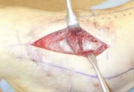 Illustration 11 for Talar Neck Fracture Treatment: Optimizing Recovery with ORIF