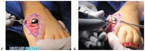 Illustration 48 for End Articular Cartilage Loss: Arthrosurface HemiCAP Resurfacing