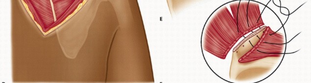 Illustration 17 for Snapping Scapula Syndrome: Why Your Shoulder Clicks & What to Do