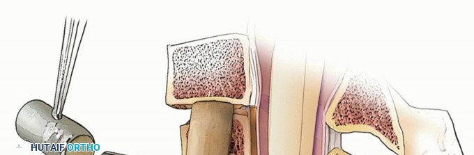 Illustration 26 for Stop Numbness & Instability: Corpectomy and Fusion Guide