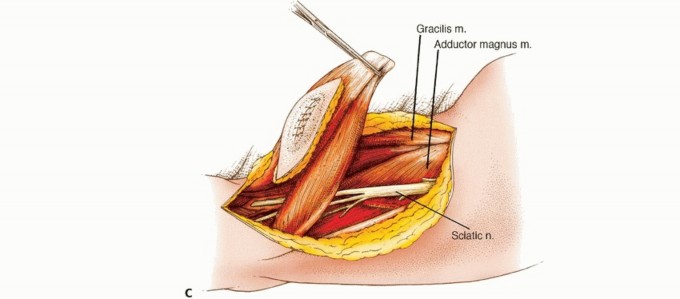 Illustration 17 for Posterior Thigh Resection: Rethinking Outcomes & Limb Sparing