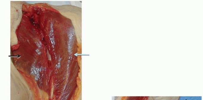 Illustration 6 for Irreparable Subscapularis Tears? Explore Pectoralis Major Transfer.