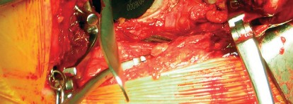 Illustration 32 for Cemented Component Longevity: The Critical Margin of the Acetabulum