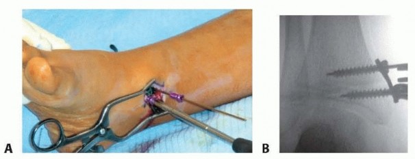 Illustration 11 for Optimizing Growth to Correct Pediatric Limb Deformities
