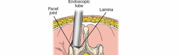 Illustration 5 for Minimally Invasive Posterior Approach: Techniques, Benefits & Recovery