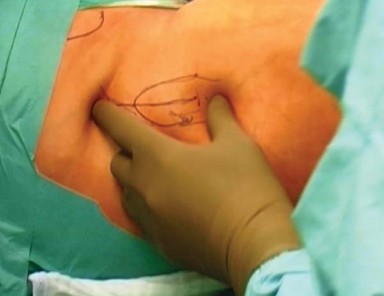 Illustration 2 for Mastering the Anterolateral Approach in Minimally Invasive Hip Replacement