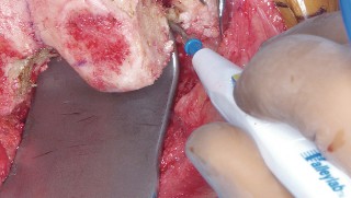 Illustration 52 for Mastering Valgus Total Knee Replacement: Techniques & Pitfalls