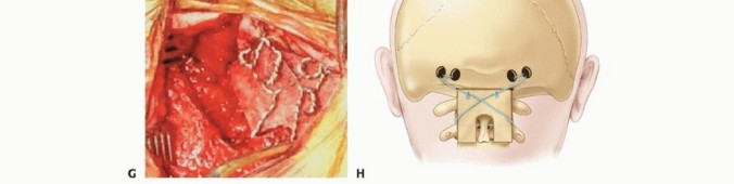 Illustration 25 for Addressing Cervical Spine Instability with Posterior Arthrodesis