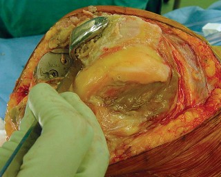 صورة طبية: مراجعة استبدال الركبة الجزئي الفاشل دليلك الشامل للعلاج الناجح في صنعاء