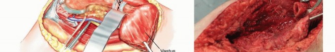 Illustration 43 for Mastering Femoral Metastases: Optimal Function for Femoris & Vastus