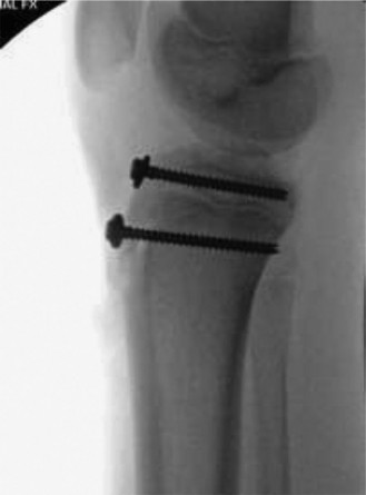 Illustration 4 for Pediatric Cases: Optimal Closure of the Distal Femur