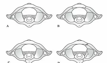 صورة توضيحية لـ كسور الفقرة الأطلسية (C1): دليل شامل للمرضى نحو الشفاء والتعافي مع الأستاذ الدكتور محمد هطيف