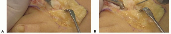 Illustration 16 for Plantar Plate Repair: End Lesser Toe Pain & Instability