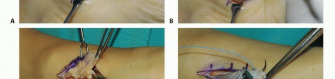 Illustration 6 for Foot Drop Surgery: How a Pin or Drill Elevates Tendon Transfer