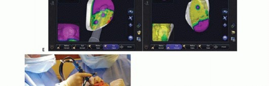 صورة طبية: استبدال مفصل الركبة الجزئي: حل متقدم لآلام الركبة المستمرة مع الأستاذ الدكتور محمد هطيف