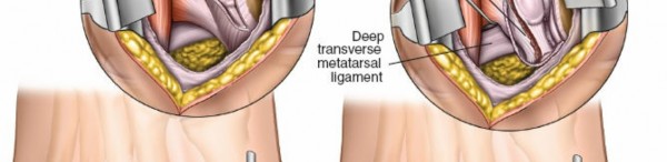 Illustration 211 for Optimized Approaches to the Dorsum of the Foot & Ankle