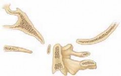 Illustration 4 for Cervical Fusion: The Line is Drawn for Lasting Stability