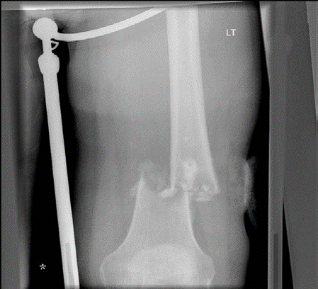 Conquer Your Examination Question: Chondrosarcoma