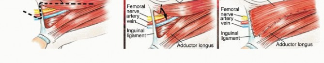 Illustration 10 for Optimizing Resection: An Overview of Surgical Approaches for Space Sarcomas