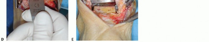 Illustration 24 for HINTEGRA Total Ankle: Unlocking Natural Ankle Movement