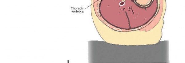 Illustration 324 for Approach to the Lumbar Spine: Mastering Techniques & Anatomy